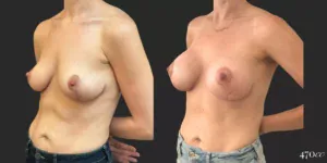 Breast Augmentation #74, before and after photo, view 2