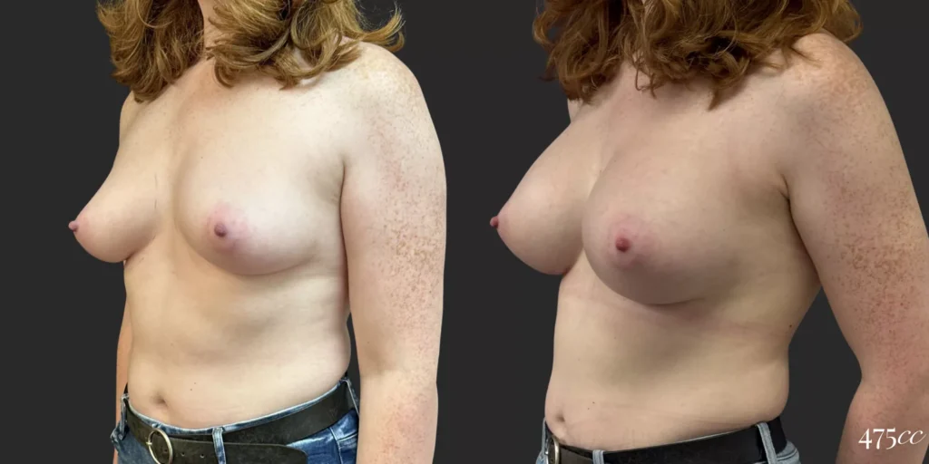 Breast Augmentation #75, before and after photo, view 2