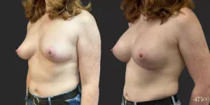 Breast Augmentation #75, before and after photo, view 2