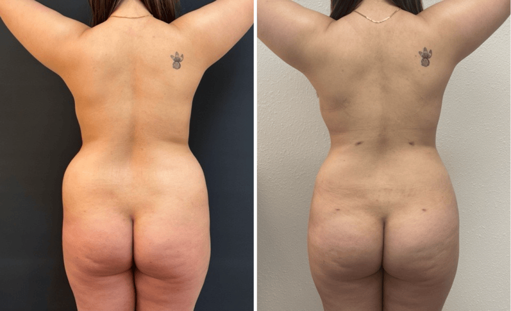 Lipo Breast Augmentation #003, before and after photo, view 3