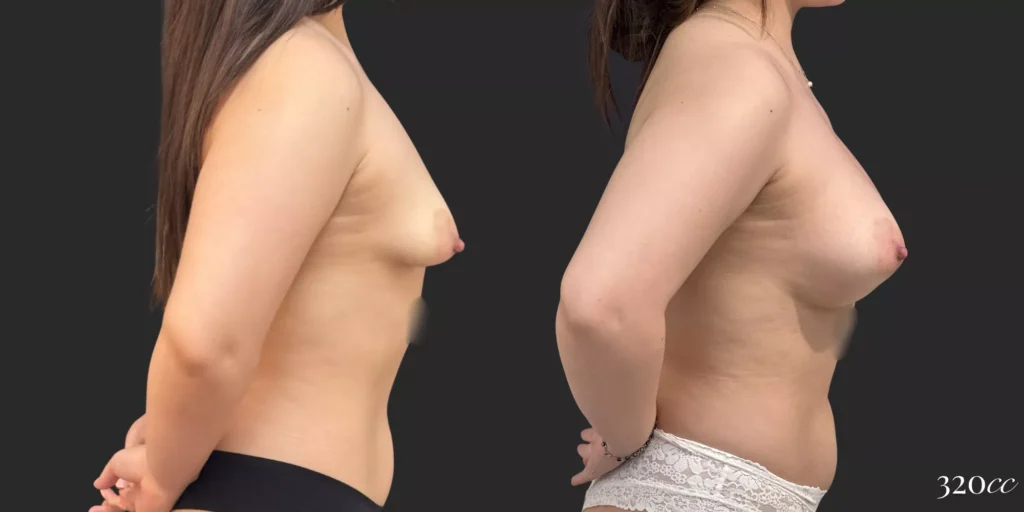 Breast Augmentation #73, before and after photo, view 3