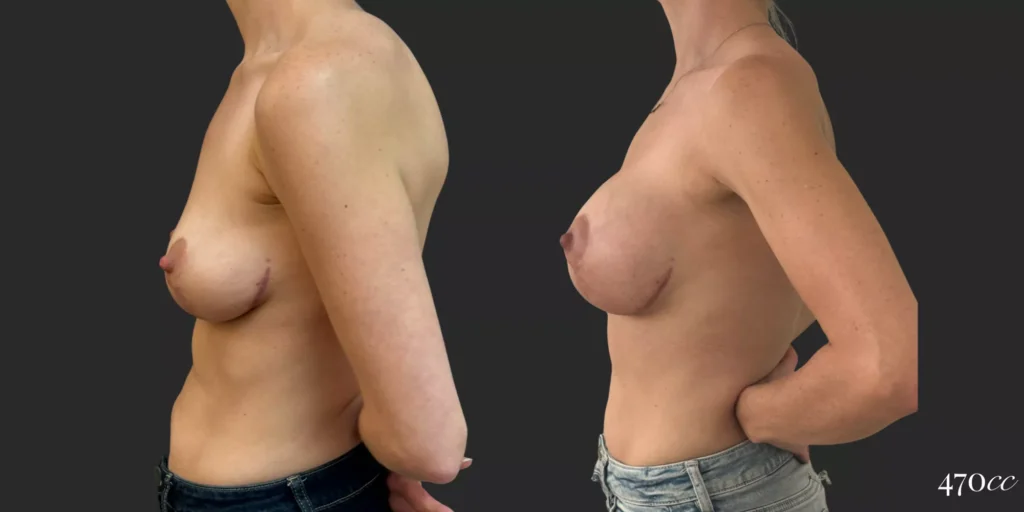 Breast Augmentation #74, before and after photo, view 3