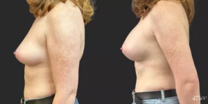 Breast Augmentation #75, before and after photo, view 3