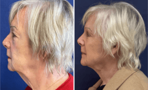 Face & Neck Lift #006, before and after photo, view 2
