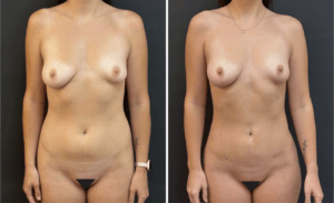 Liposuction #27, before and after photo