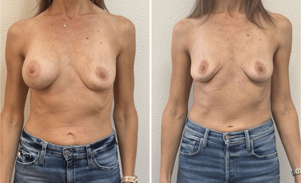Breast Implant Removal #04, before and after photo