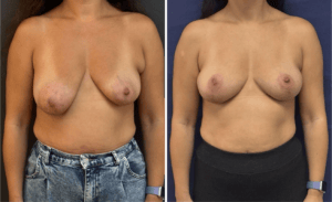 Breast Lift #007, before and after photo