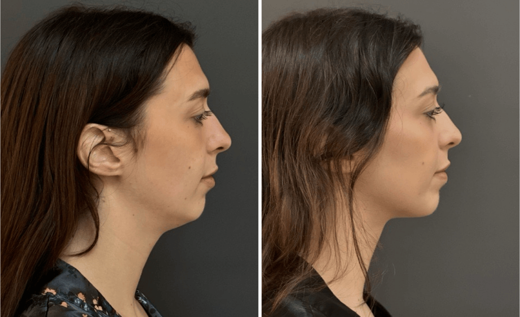 Chin Liposuction #001, before and after photo