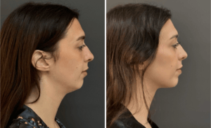 Chin Liposuction #001, before and after photo