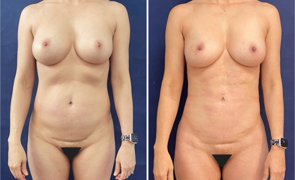 Liposuction #28, before and after photo