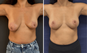 Breast Lift #007, before and after photo, view 3