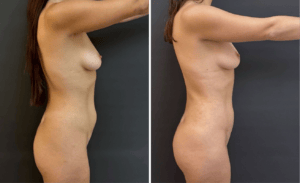 Liposuction #27, before and after photo, view 3