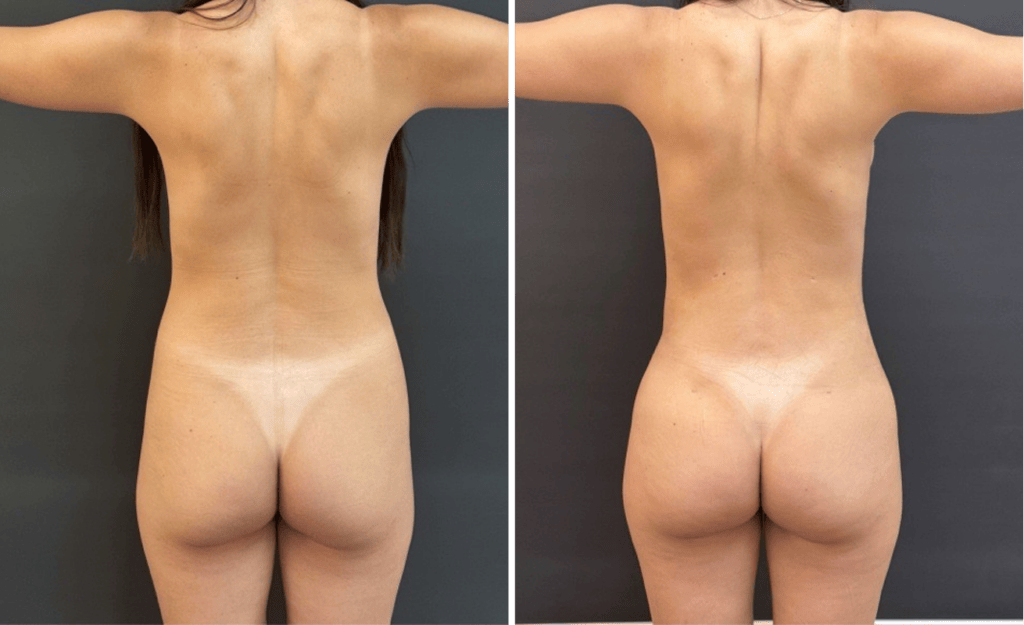 Liposuction #27, before and after photo, view 4