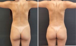 Liposuction #27, before and after photo, view 4