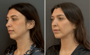 Chin Liposuction #001, before and after photo, view 2