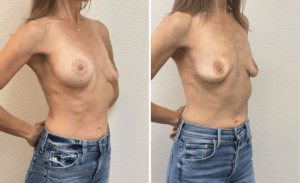 Breast Implant Removal #04, before and after photo, view 2