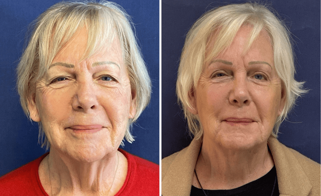 Face & Neck Lift #006, before and after photo