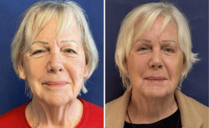 Face & Neck Lift #006, before and after photo