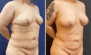 Liposuction #29, before and after photo, view 3