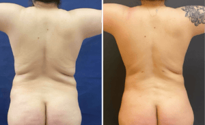 Liposuction #29, before and after photo, view 2