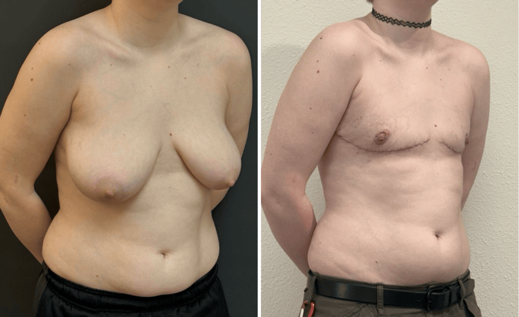 Gender Affirming Surgery #005, before and after photo, view 2