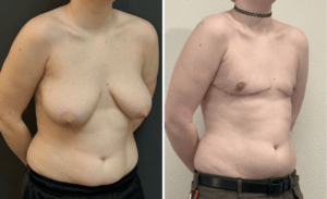 Gender Affirming Surgery #005, before and after photo, view 2