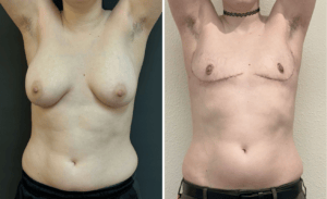 Gender Affirming Surgery #005, before and after photo, view 3