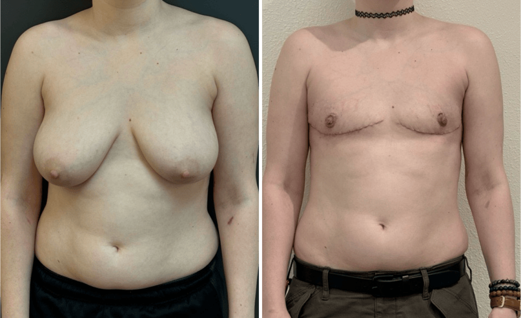 Gender Affirming Surgery #005, before and after photo