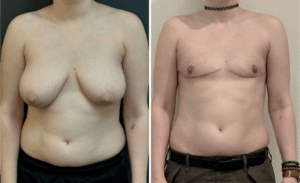 Gender Affirming Surgery #005, before and after photo