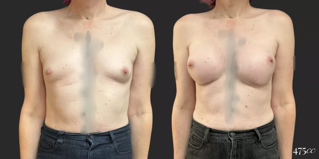 Breast Augmentation and Gender Affirming Surgery #76, before and after photo