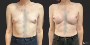 Breast Augmentation and Gender Affirming Surgery #76, before and after photo