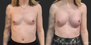 Breast Augmentation and Gender Affirming Surgery #77, before and after photo