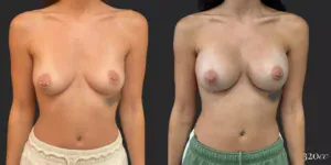 Breast Augmentation #78, before and after photo