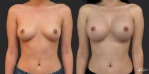 Breast Augmentation #79, before and after photo