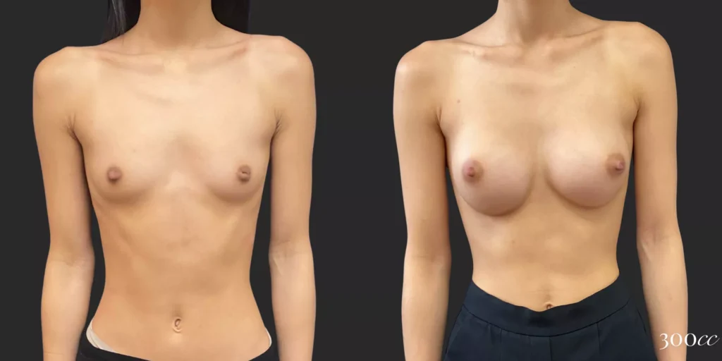 Breast Augmentation #81, before and after photo