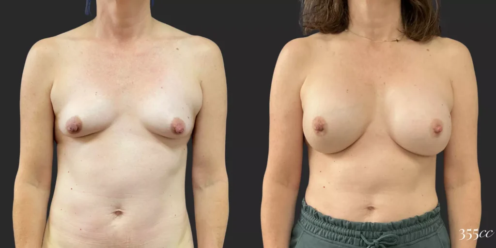 Breast Augmentation #83, before and after photo