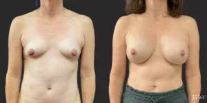 Breast Augmentation #83, before and after photo