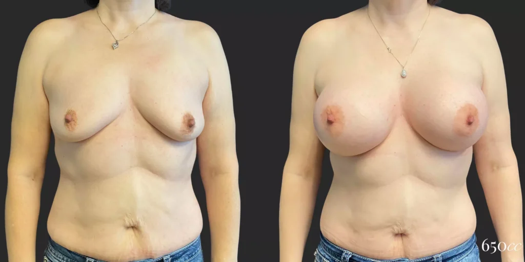 Breast Augmentation #85, before and after photo