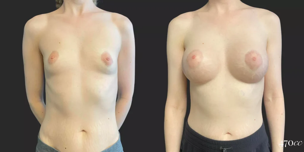 Breast Augmentation #86, before and after photo