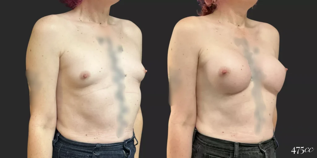 Breast Augmentation and Gender Affirming Surgery #76, before and after photo, view 2