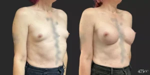 Breast Augmentation and Gender Affirming Surgery #76, before and after photo, view 2