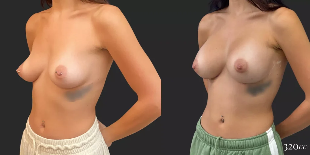 Breast Augmentation #78, before and after photo, view 2