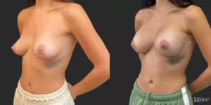 Breast Augmentation #78, before and after photo, view 2