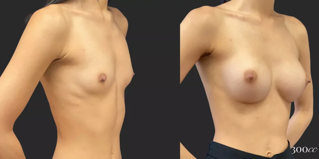 Breast Augmentation #81, before and after photo, view 2