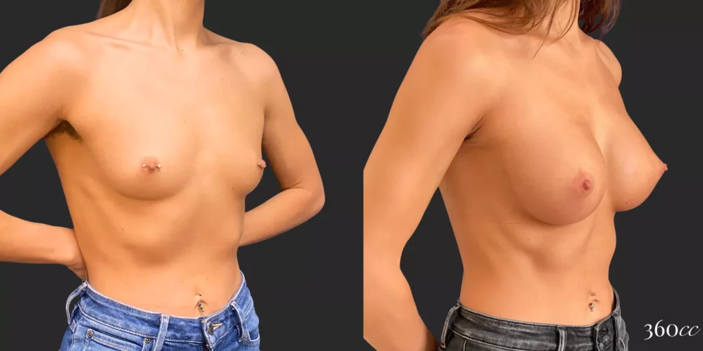 Breast Augmentation #82, before and after photo, view 2