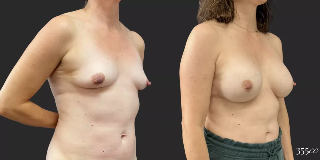 Breast Augmentation #83, before and after photo, view 2