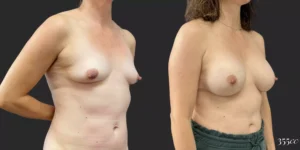 Breast Augmentation #83, before and after photo, view 2
