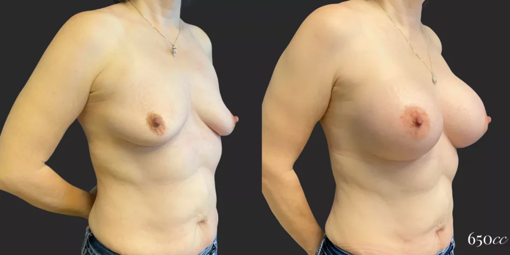 Breast Augmentation #85, before and after photo, view 2