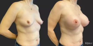 Breast Augmentation #85, before and after photo, view 2