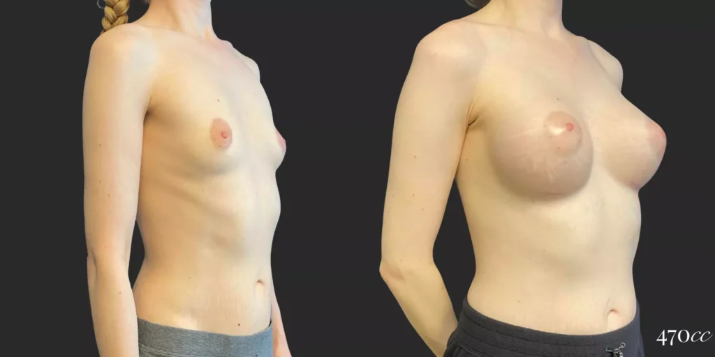Breast Augmentation #86, before and after photo, view 2